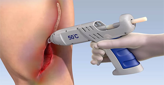 Biological glue gun for wound healing