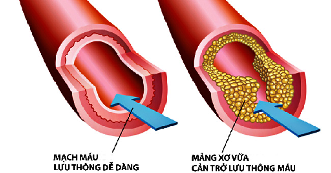 Blood lipid disorders and non-drug treatments