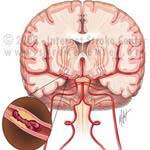 Blood tests help predict stroke