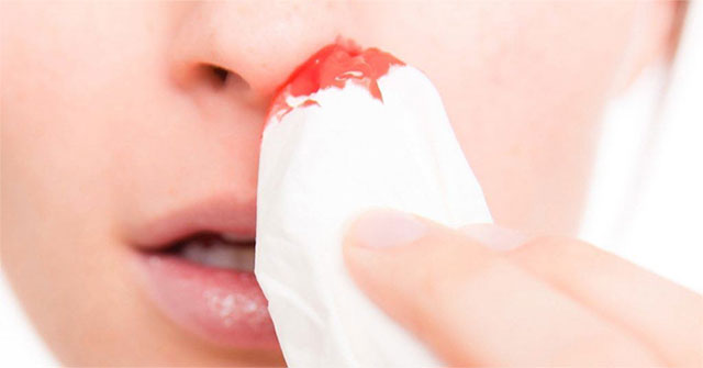 Bloody nose, cause?