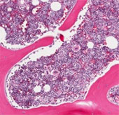 Bone marrow transplant to treat AIDS