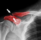 Bone regeneration with magnetic nanoparticles