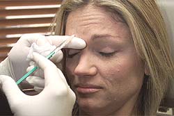 Botox, effective remedy for wound healing without scarring