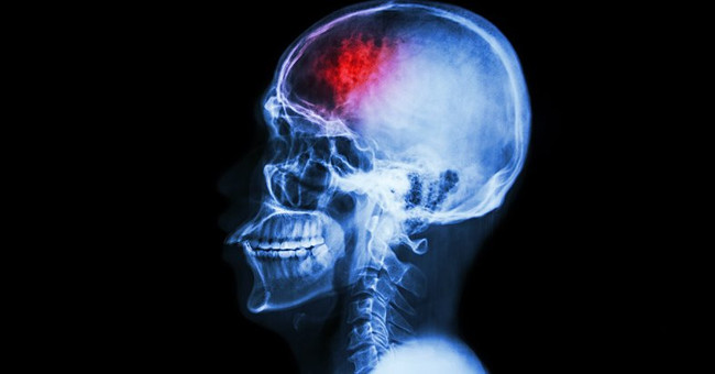 Bowel bacteria can cause brain damage, stroke