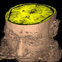 Brain circuit button to stop bleeding in the brain