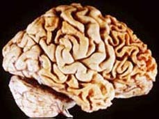 Brain damage develops extraordinary abilities