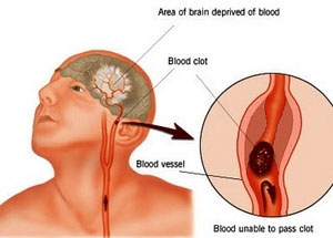 Brain nerve circuit changes lead to ma chi pain