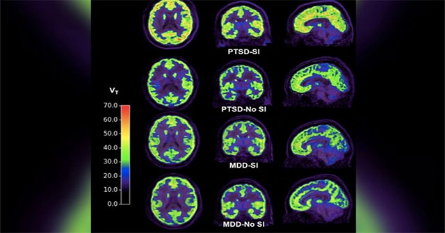 Brain scans may soon detect suicidal intent