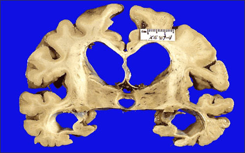 Brain shrinks before finding Alzheimer's disease
