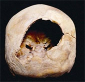Brain surgery can take place 3,000 years ago