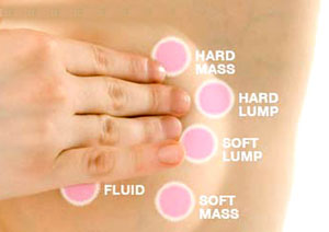 Breast cancer is related to hormone replacement therapy
