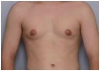 Breast enlargement - common in men