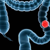 Breath test helps detect colorectal cancer