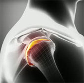 Breeding human cartilage in the laboratory