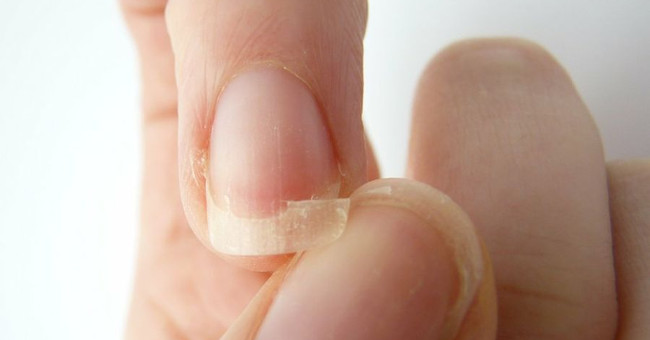 Broken nails: 6 common causes and quick fixes
