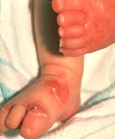 Burns skin - Things to know