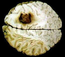 Can prevent brain cancer by vaccine