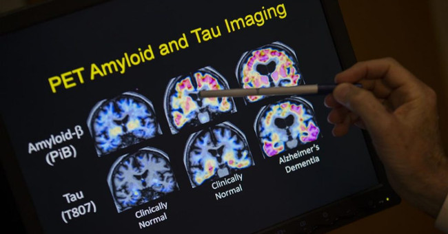 Can treat Alzheimer's disease without medication