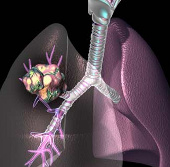 Canada applies 3D technology to treat lung cancer