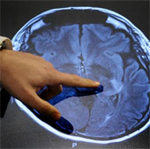 Cancer drug prevents transplant rejection