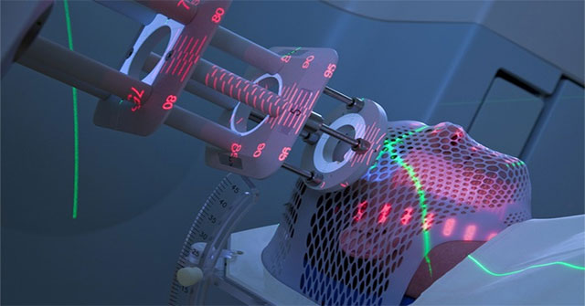 Cancer patients need only 6 radiation treatments thanks to new techniques