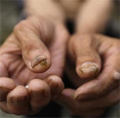 Cancer village in China