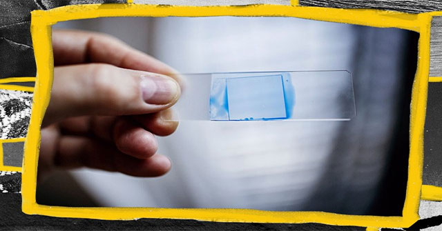 Candida auris - The mysterious drug resistant fungus threatens the survival of all humanity