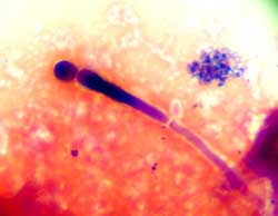 Candida vaginal vaginosis
