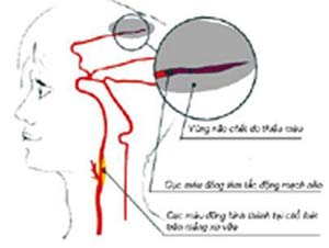 Carotid artery stenosis - one of the causes of stroke