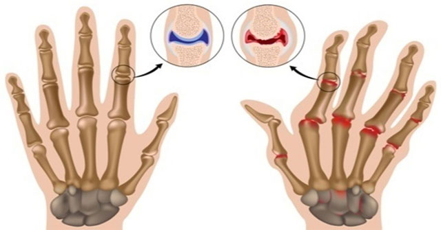 Causes and risk factors of rheumatoid arthritis (Part 1)