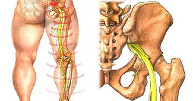 Causes and treatment of sciatica