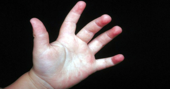 Causes and ways of coping when children sweat a lot of hands and feet