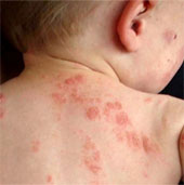 Causes and ways to cure eczema