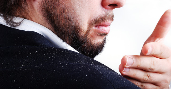 Causes of dandruff on the scalp