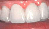 Causes of gum disease