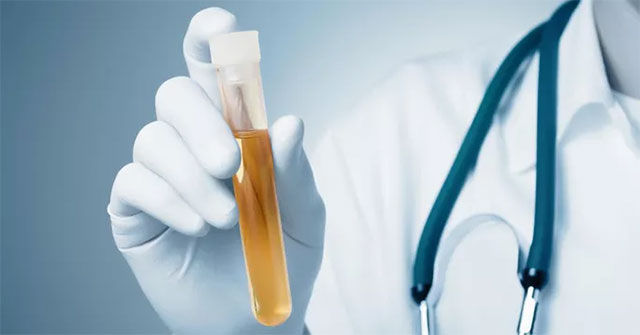 Change urine color, detect 1 type of cancer very accurately