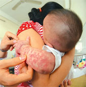 Chickenpox easily attacks young children in the cold season