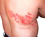 Chickenpox - precursor to shingles