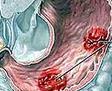 Children also have stomach ulcers
