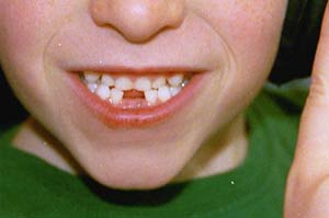 Children are more cavities