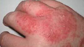 Children today and 'pandemic' allergies