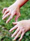 Children with chronic arthritis suffer from complications