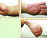 Children with Kawasaki are susceptible to coronary artery disease