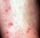 China declared a vaccine for hand-foot-mouth disease
