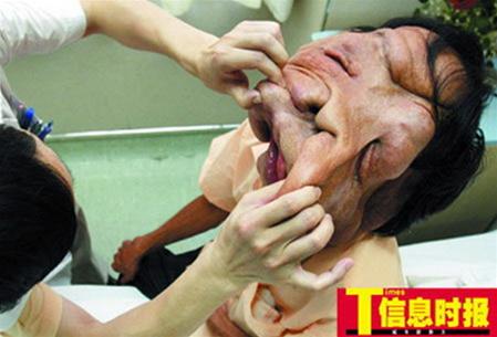 China: Facial surgery for 'elephants'