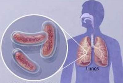 China makes a new draft to help review tuberculosis