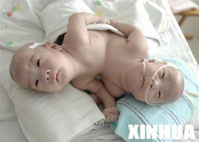 China: Separation of conjoined twins