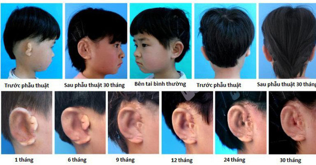 China successfully cultivates and implants ears from cartilage cells