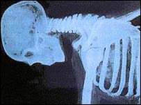 China: successfully implanted spinal disc