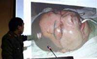 China successfully performed the first face transplant